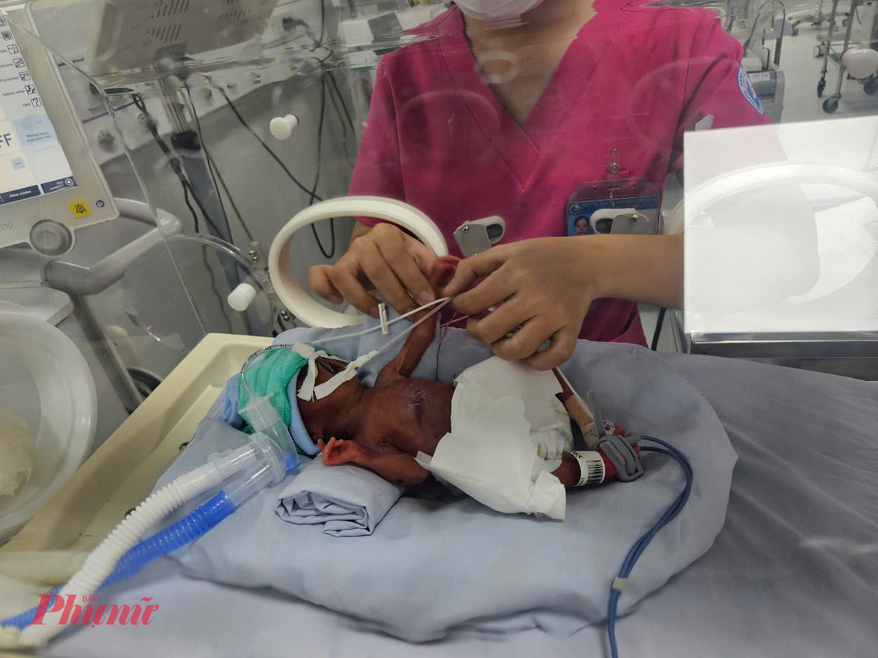 Chiến binh nhí nặng hơn 700gram, người đầy dây nhợ nhưng luôn cố gắng từng ngày