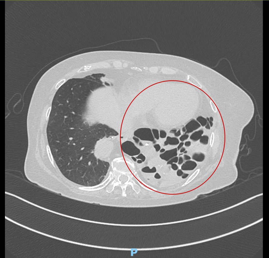 Phim chụp CT cho thấy phần phổi bên trái của bệnh nhân đã bị tổn thương nặng - Ảnh:FV