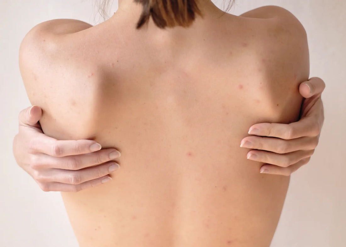 Lưng là vùng dễ bị mụn nhưng khó có thể 