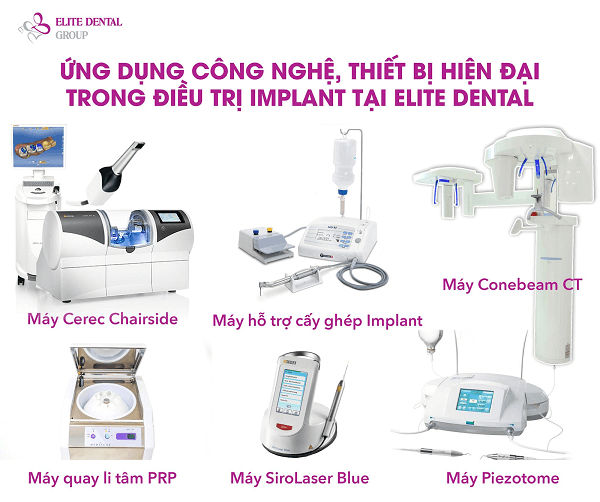 Ứng dụng công nghệ vào trồng răng implant