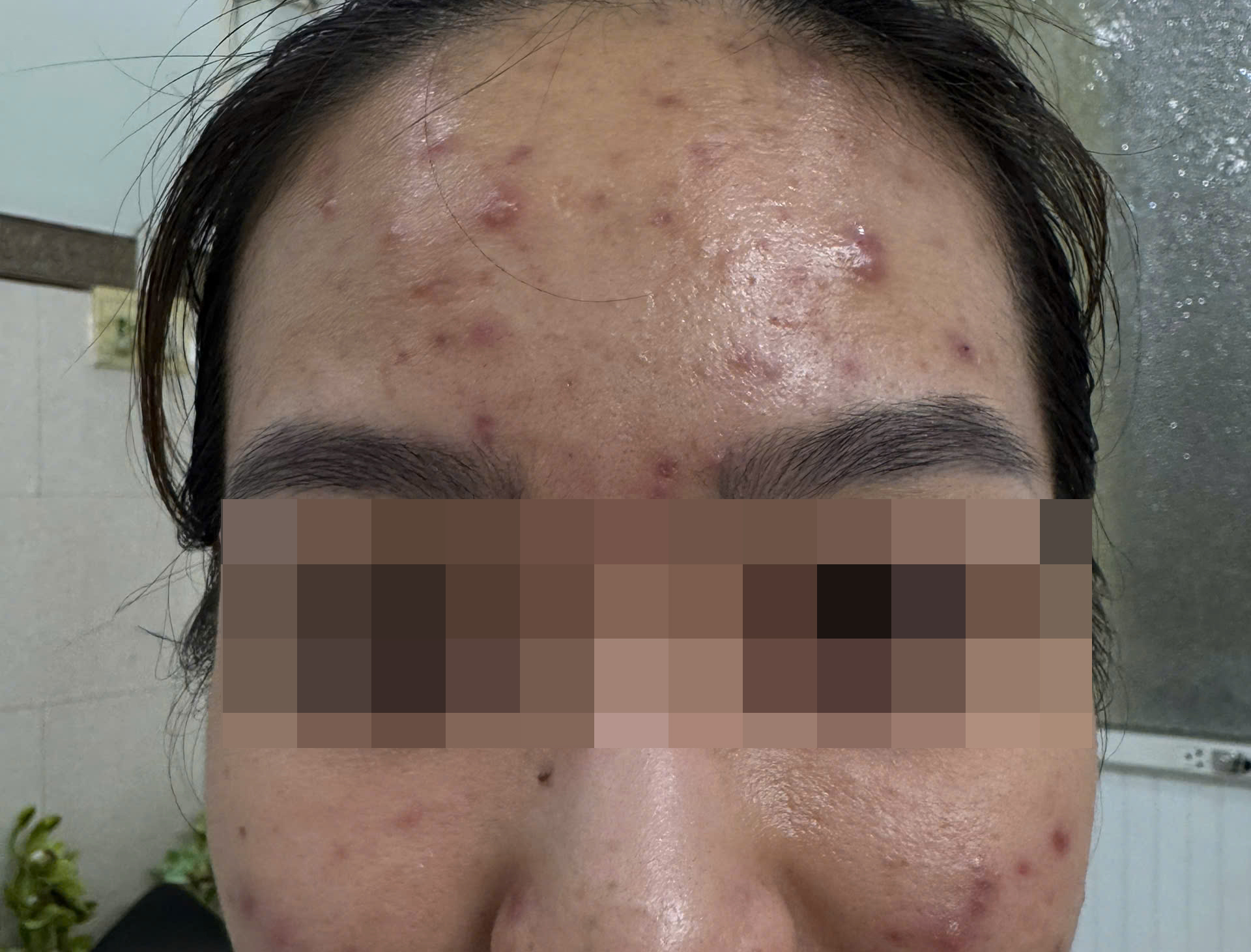 Ban đầu, K. chỉ bị vài nốt mụn rải rác. Sau khi uống sản phẩm giải độc gan khoảng 1 tuần thì mụn bùng phát chi chít đầy mặt khiến cô nữ sinh bị ảnh hưởng tâm lý trầm trọng, phải đến bệnh viện khám (ảnh: T. V.)