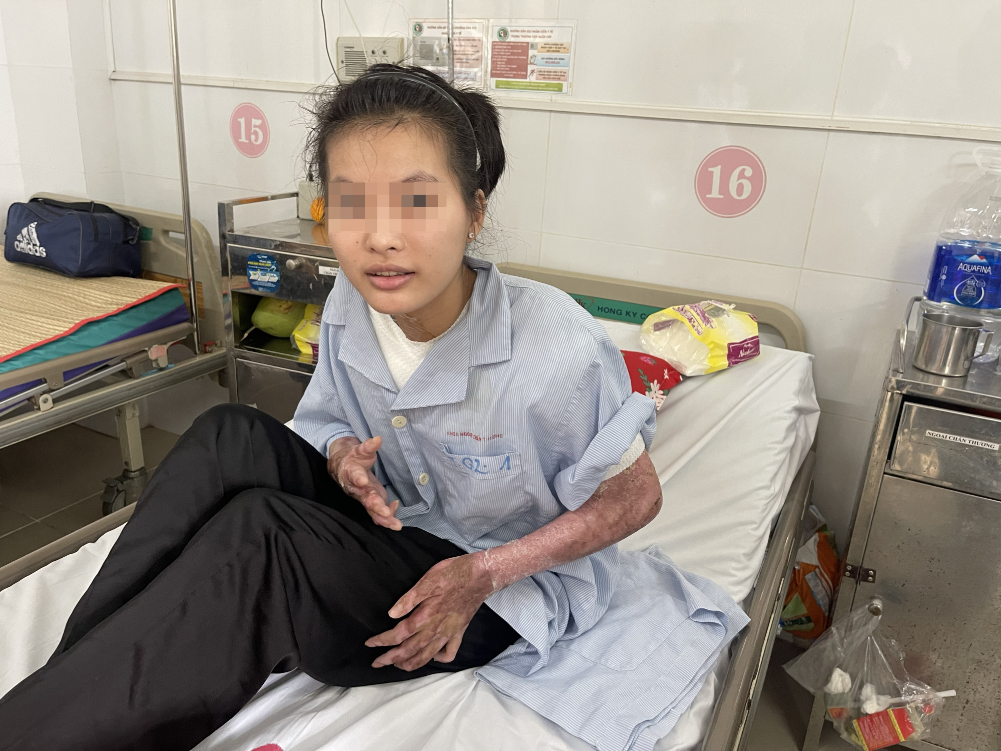 Em T. đang được theo dõi tại Khoa Ngoại Chấn thương Bệnh viện Lê Văn Thịnh do vết bỏng bị nhiễm trùng, có mủ (ảnh: Thanh Huyền).