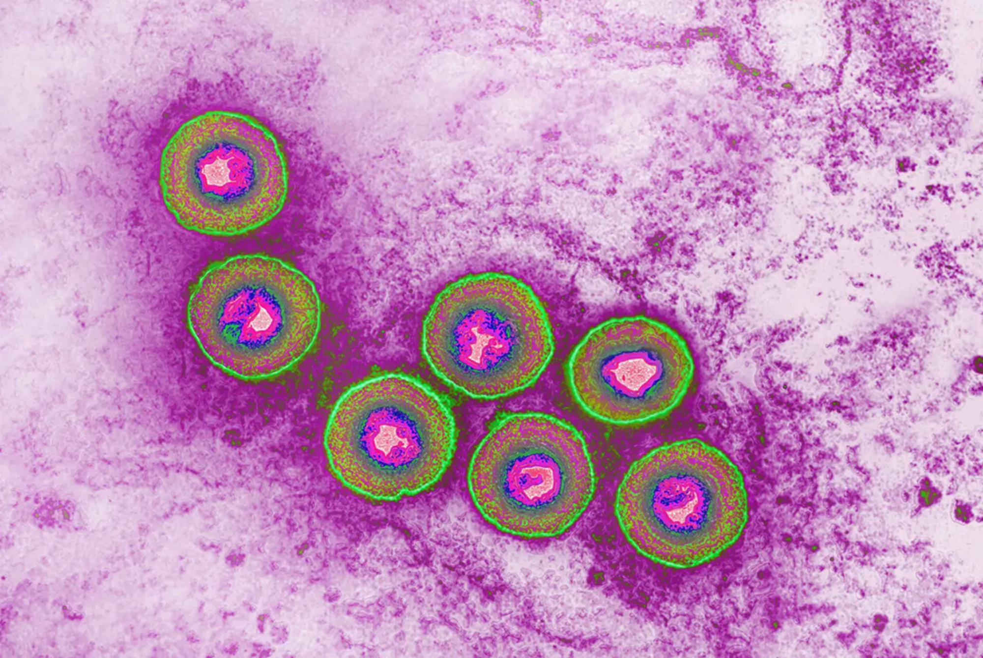 Hình ảnh dưới kính hiển vi điện tử của vi-rút herpes, loại vi-rút được kỳ vọng đóng vai trò then chốt trong cuộc chiến chống ung thư da ác tính — Ảnh: Getty Images
