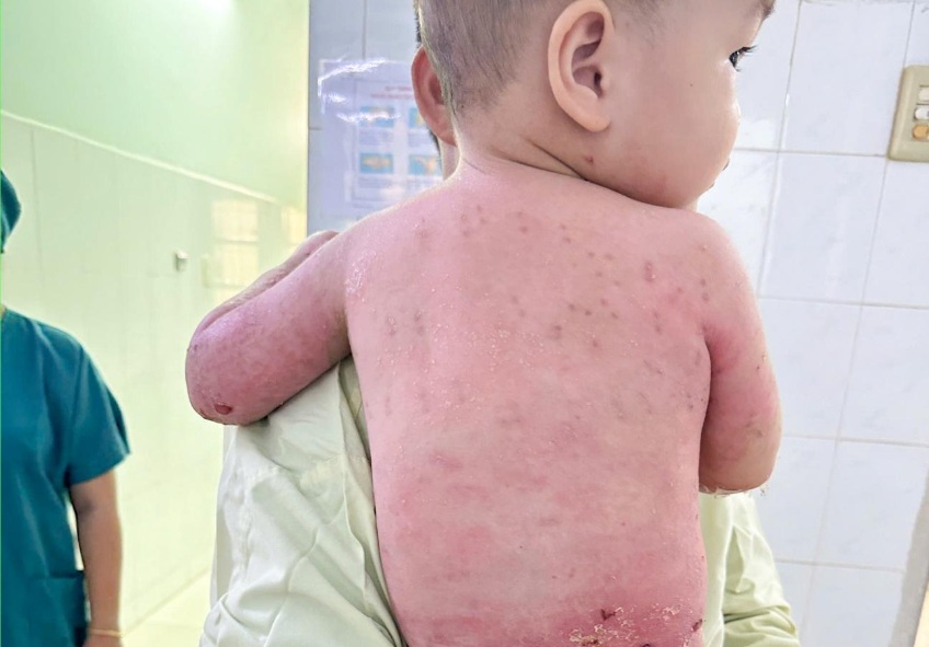 Nhờ kỹ thuật ghép da, các vết bỏng trên người bé T. gần như đã lành lặn, ảnh BVCC