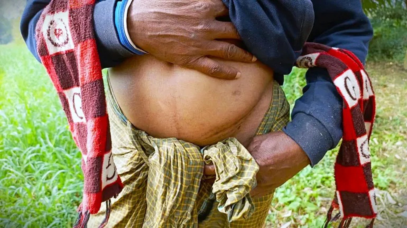 Vết sẹo trên cơ thể Safiruddin sau lần bán thận - ẢNH: AMINUL ISLAM MITHU (Al Jazeera)