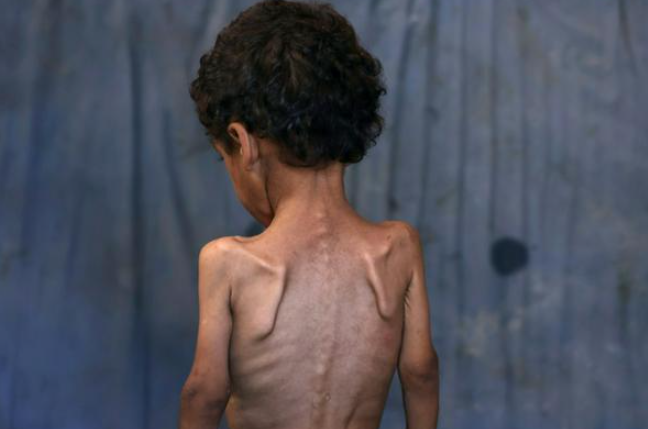 Hầu hết trẻ em ở Gaza bị suy dinh dưỡng và mỗi ngày đều có em chết 