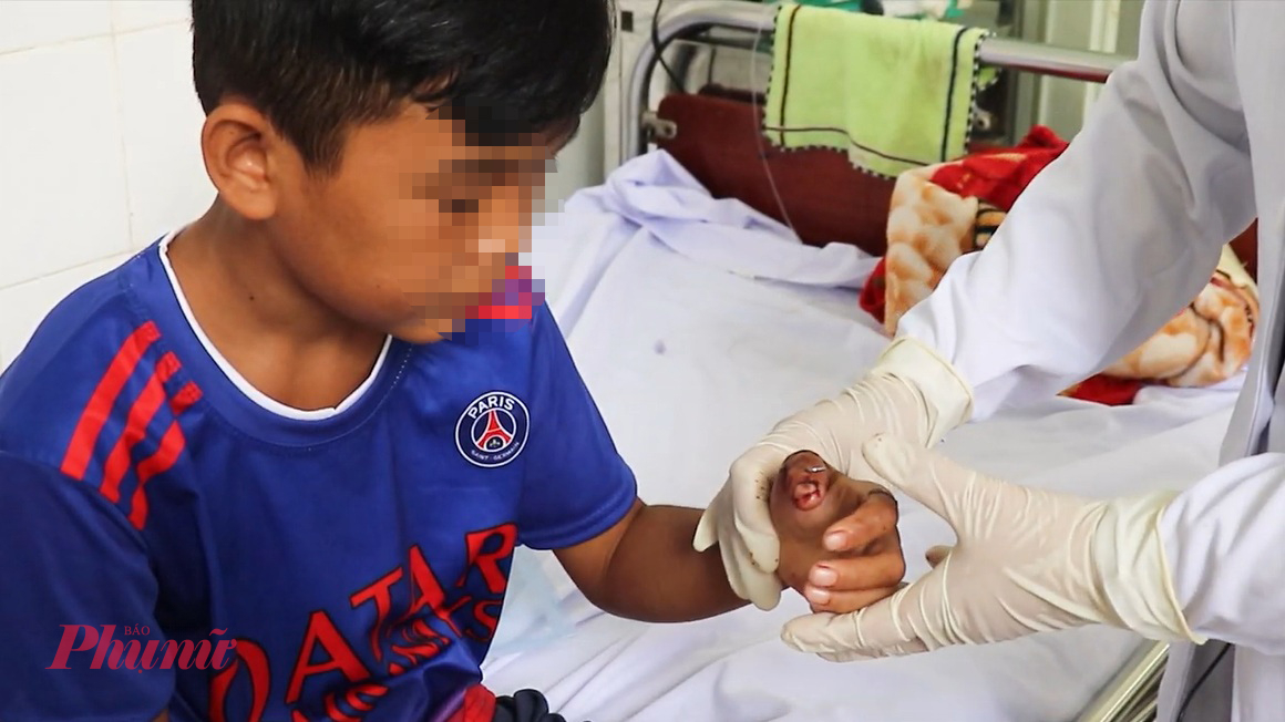 Bác sĩ kiểm tra vết thương cho em H. sau phẫu thuật