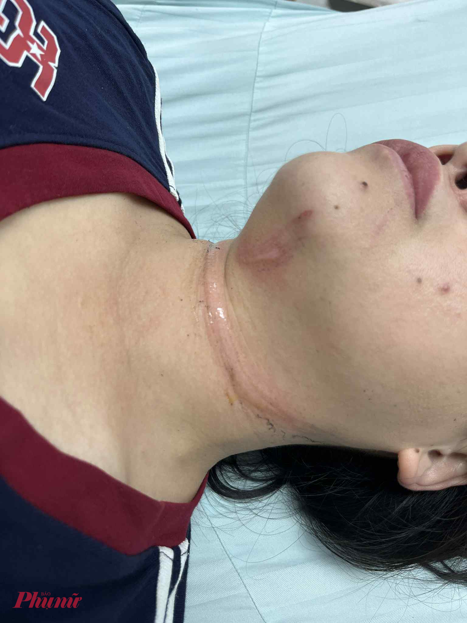 Vết thương ngang cổ người phụ nữ.