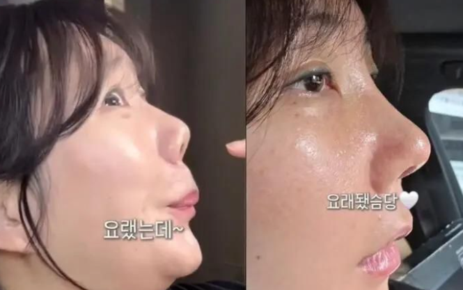 diễn viên hài Hàn Quốc Heo Anna đã thu hút sự chú ý của công chúng sau khi tiết lộ cô đã trải qua phẫu thuật sửa mũi sau 21 năm làm thủ thuật nâng mũi đầu tiên.
