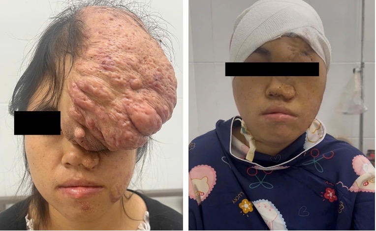 Cô gái đã phải chịu đựng khối u khổng lồ suốt 15 năm (ảnh: SYT)