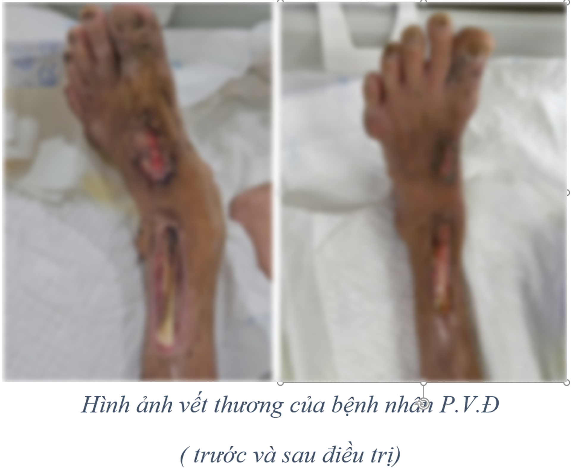 Hình ảnh các ổ áp xe