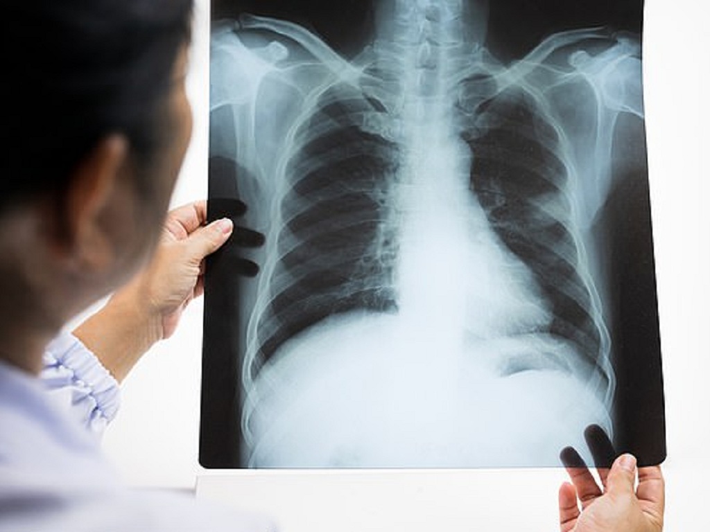 Ung thư phổi được xem là một trong 10 loại ung thư hàng đầu Việt Nam