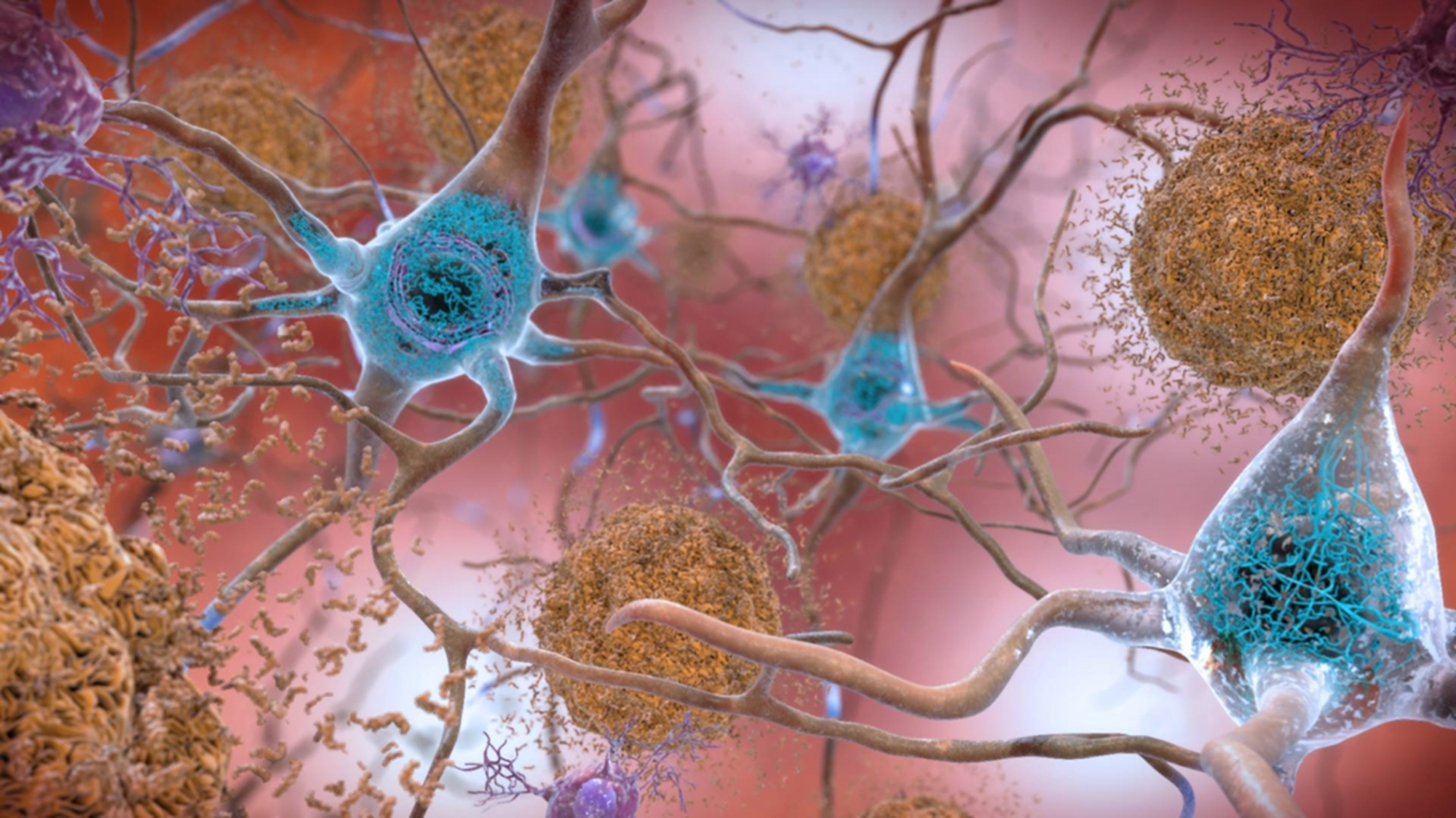 Các mảng bám amyloid (màu cam) và tau (màu xanh lam) trong não, nguyên nhân của bệnh Alzheimer — Ảnh: Trung tâm CIRA của Đại học Kyoto 