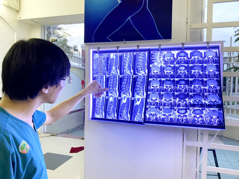 Làm sao tránh cong vẹo cột sống ở tuổi học đường? Bác sĩ Lê Cao Anh Huy đang chỉ ra tình trạng vẹo cột sống thể hiện trên phim chụp cho một bệnh nhi - ẢNH: L.H.