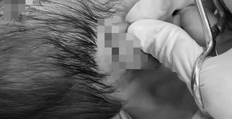 Chó dữ cắn nhiều vết thương sâu, phức tạp ở vùng đầu cháu gái 19 tháng tuổi quê (phường Hương Thủy, TP Huế) 