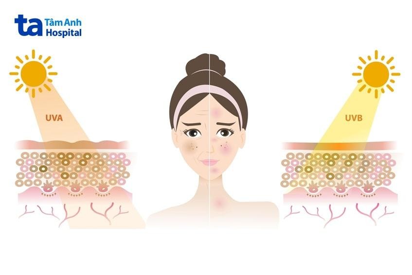 Tia UV tích lũy nhiều năm là tác nhân hàng đầu khiến nám đậm màu
