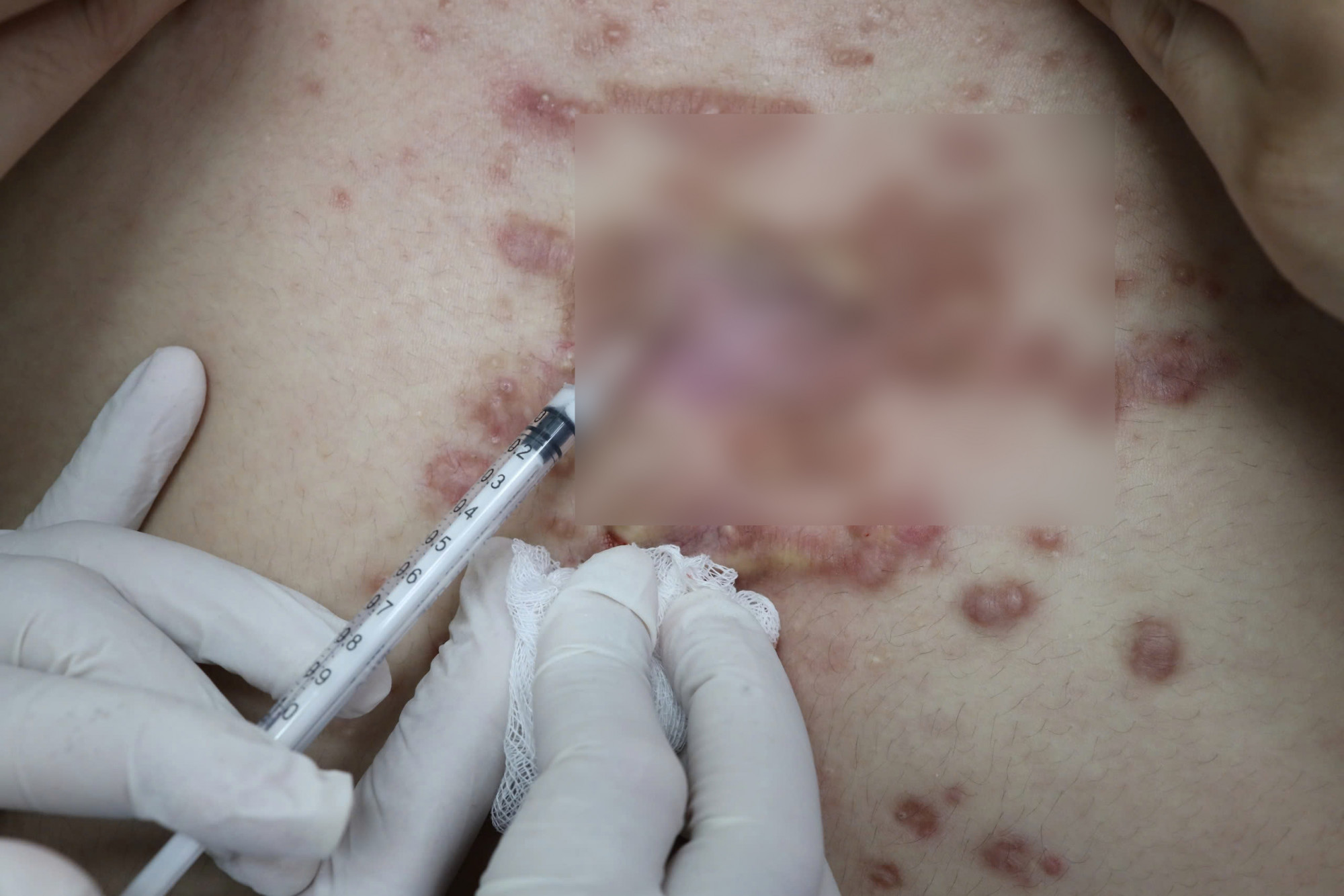 Bệnh viện Da Liễu TPHCM thường xuyên tiếp nhận người bệnh bị biến chứng khi làm đẹp ở cơ sở không uy tín, ảnh BVCC
