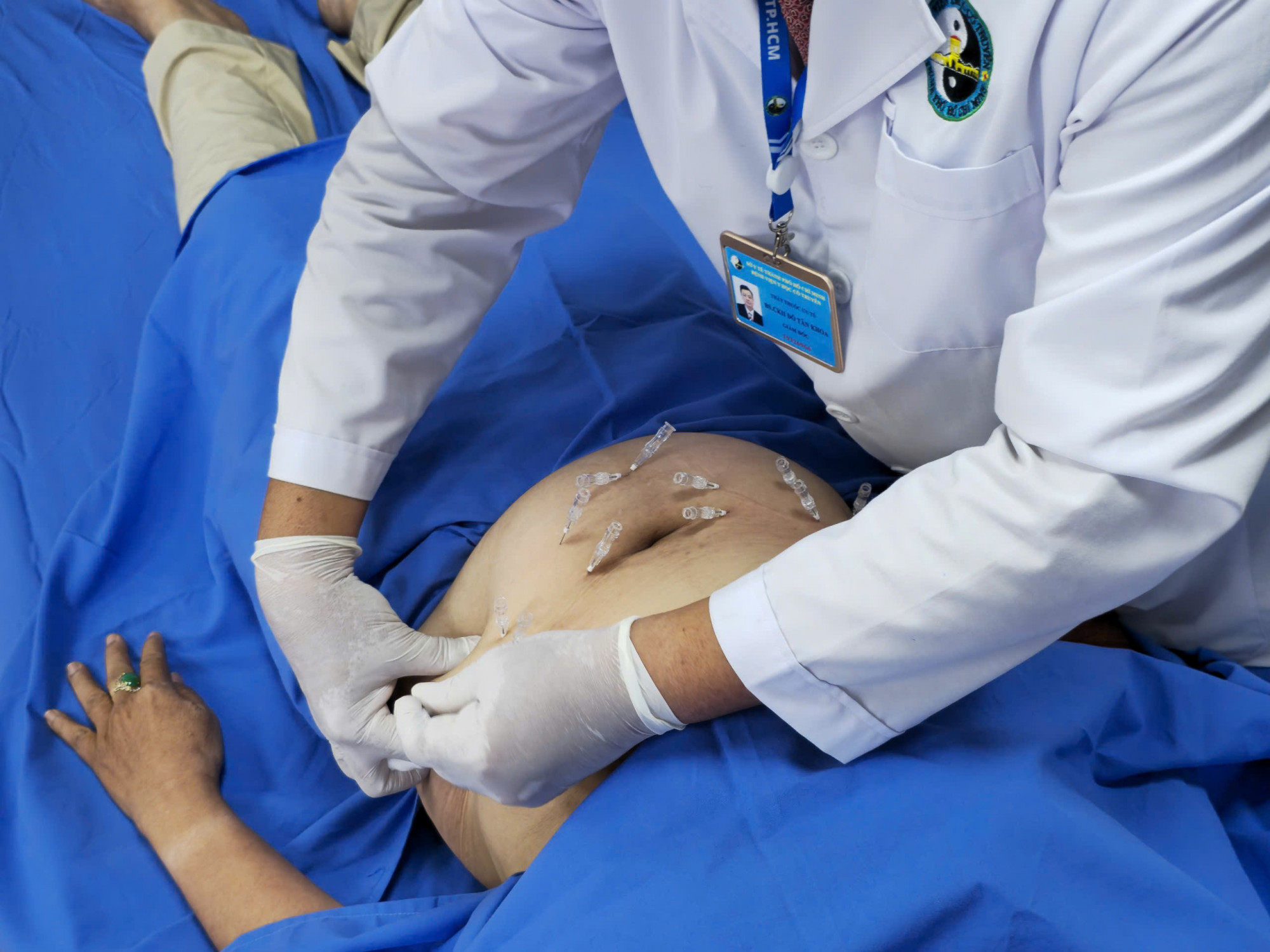 Chú thích ảnh: Một bệnh nhân đang được cấy chỉ huyệt đạo tại Bệnh viện Y học Cổ truyền TPHCM (ảnh: Đ. H.)