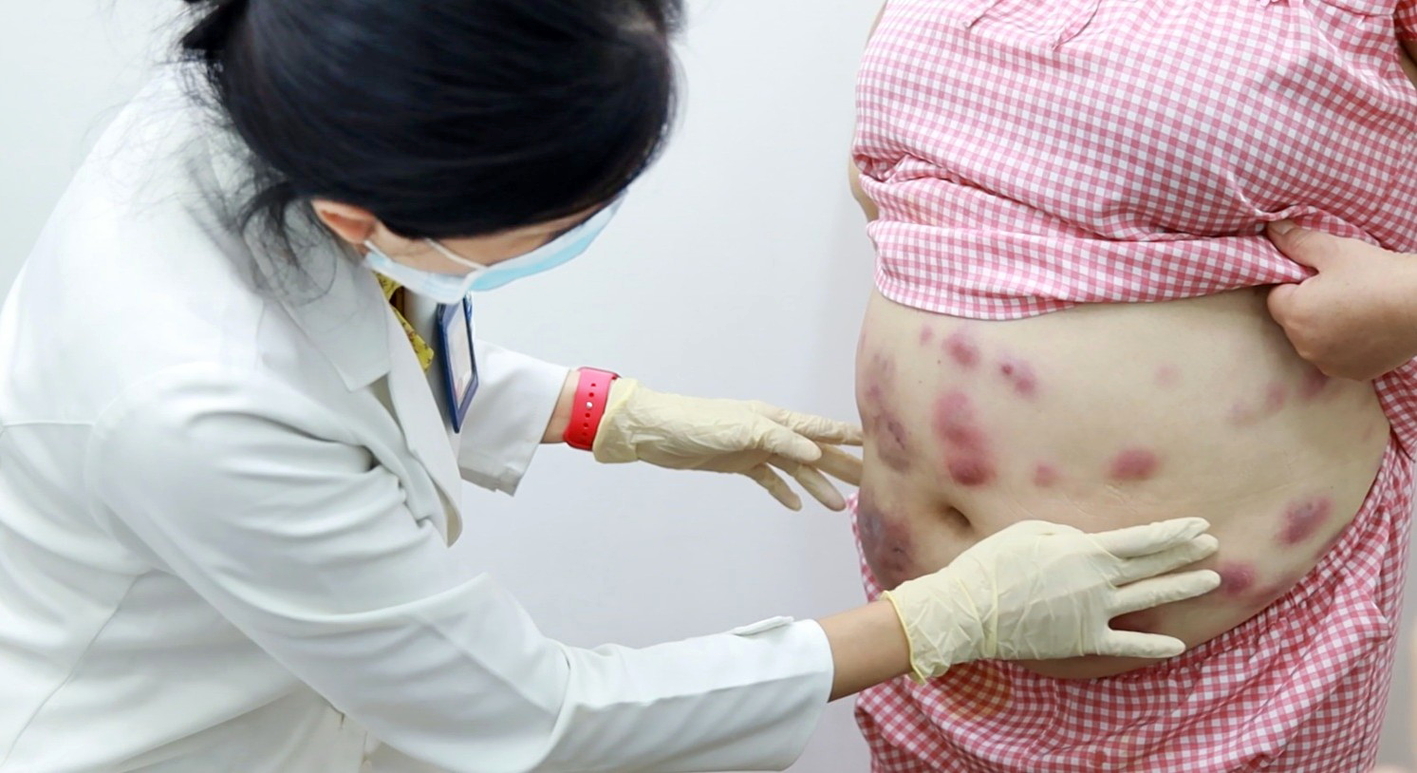 Người bệnh biến chứng sau khi hút mỡ bụng được bác sĩ Bệnh viện Da liễu TPHCM thăm khám