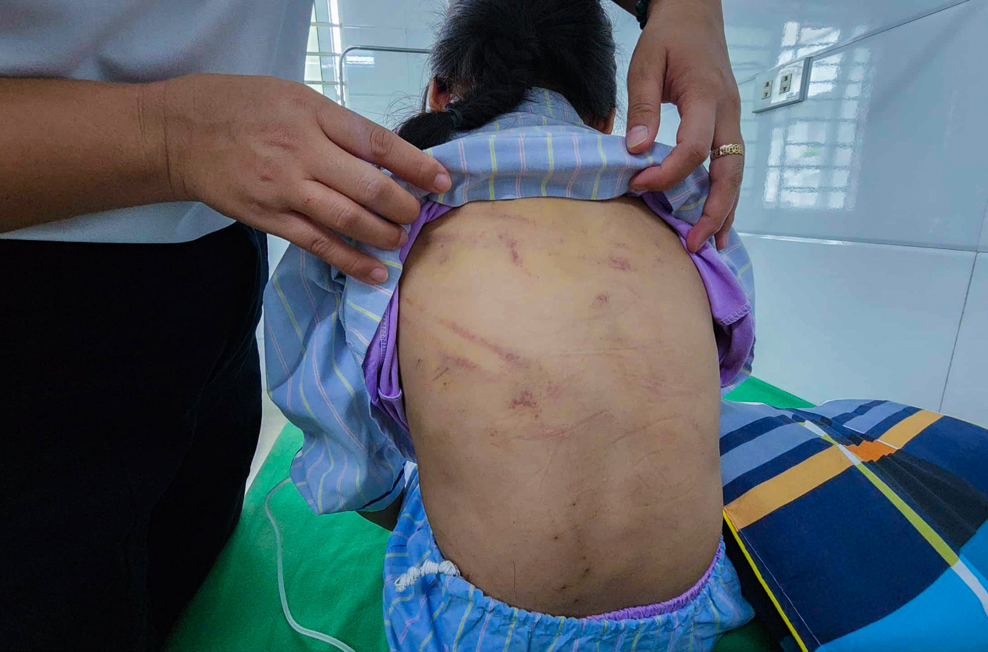 Những vết thương do đòn roi vẫn còn in trên lưng bé L. - Ảnh: Khánh Trung