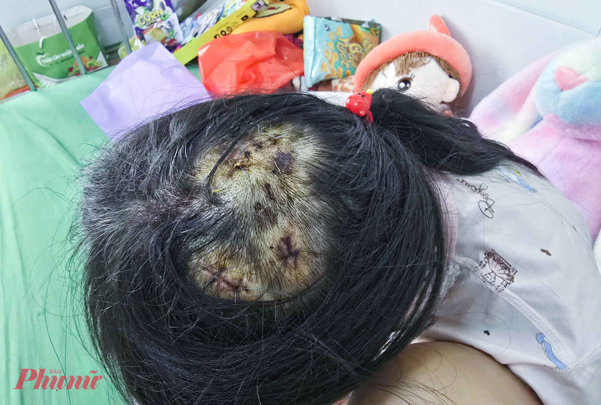 Trên đầu của bé L. phải khâu nhiều mũi do bị cha dượng dùng búa đánh