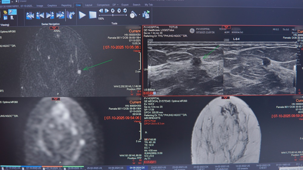 Hình chụp MRI cho thấy một tổn thương 3mm - Ảnh: FV