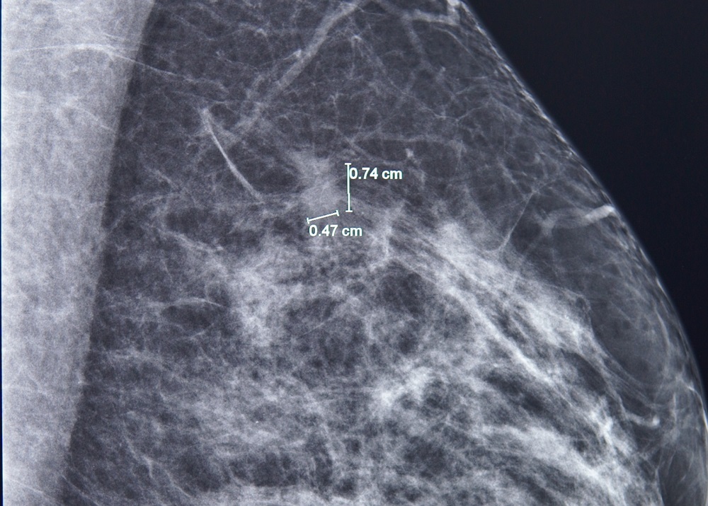 Phát hiện tổn thương 7mm ở vú trái bằng chụp nhũ ảnh - Ảnh: FV