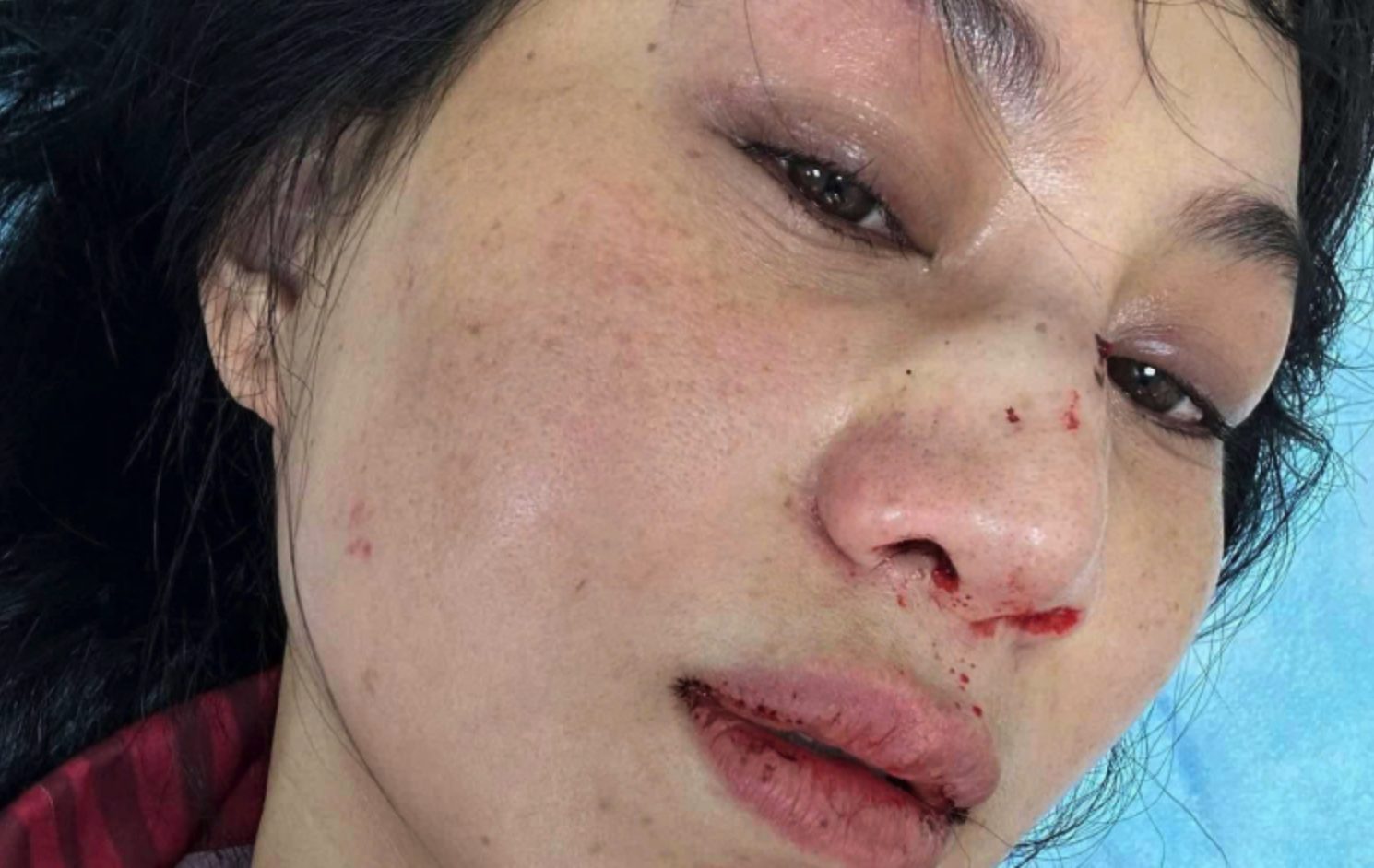 Hình ảnh thương tổn của diễn viên Phi Ngọc Ánh ( nguồn: Facebook)