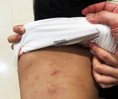 Vết bầm trên lưng bé N…. Ảnh: Hoàng Thịnh