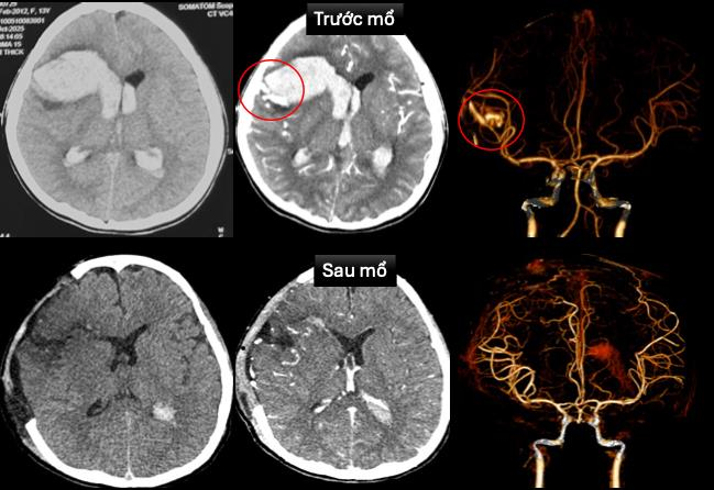 Hình ảnh chụp cắt lớp vi tính sọ não, dựng hình mạch máu não trước và sau mổ  của bé T., ảnh BV Nhi Đồng 1