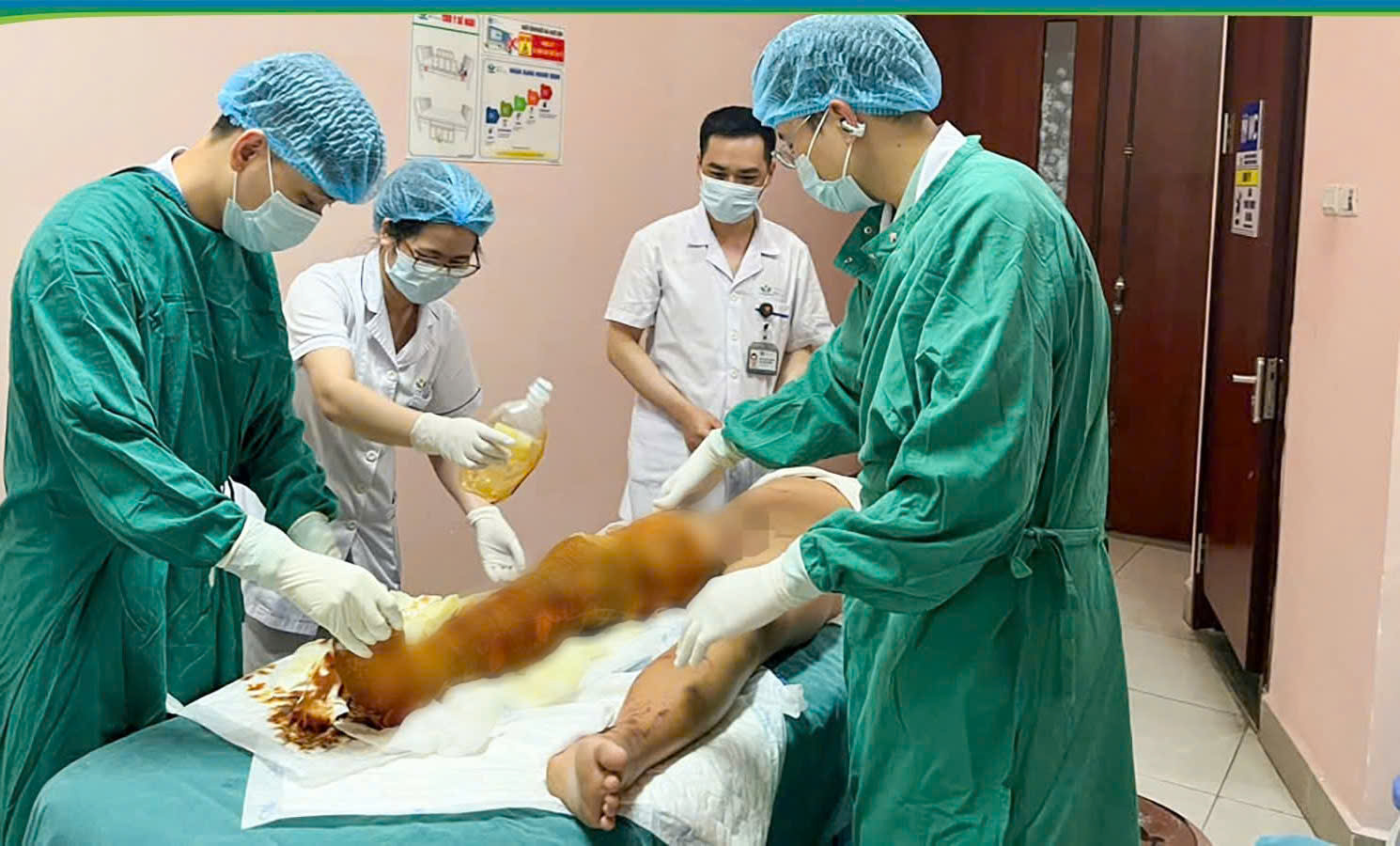 Bé trai bỏng cồn nặng