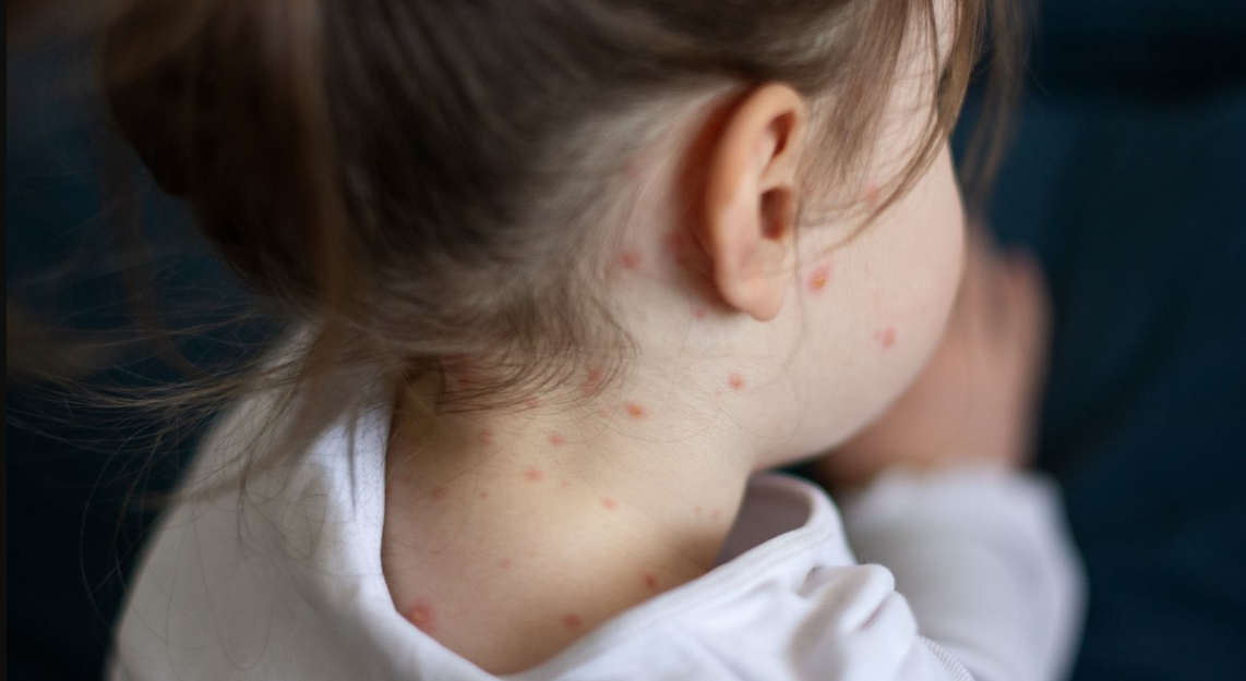 sởi là một căn bệnh có thể được kiểm soát tốt và thậm chí có thể được loại bỏ bằng các công cụ hiện có,