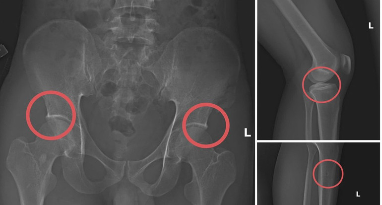 Đáng sợ khi cán bộ sử dụng nghiệp vụ y để lập đường dây trục lợi bảo hiểm Bản phim chụp XQ một số tổn thương xương do đối tượng tạo ra nhằm trục lợi tiền bảo hiểm nhân thọ.