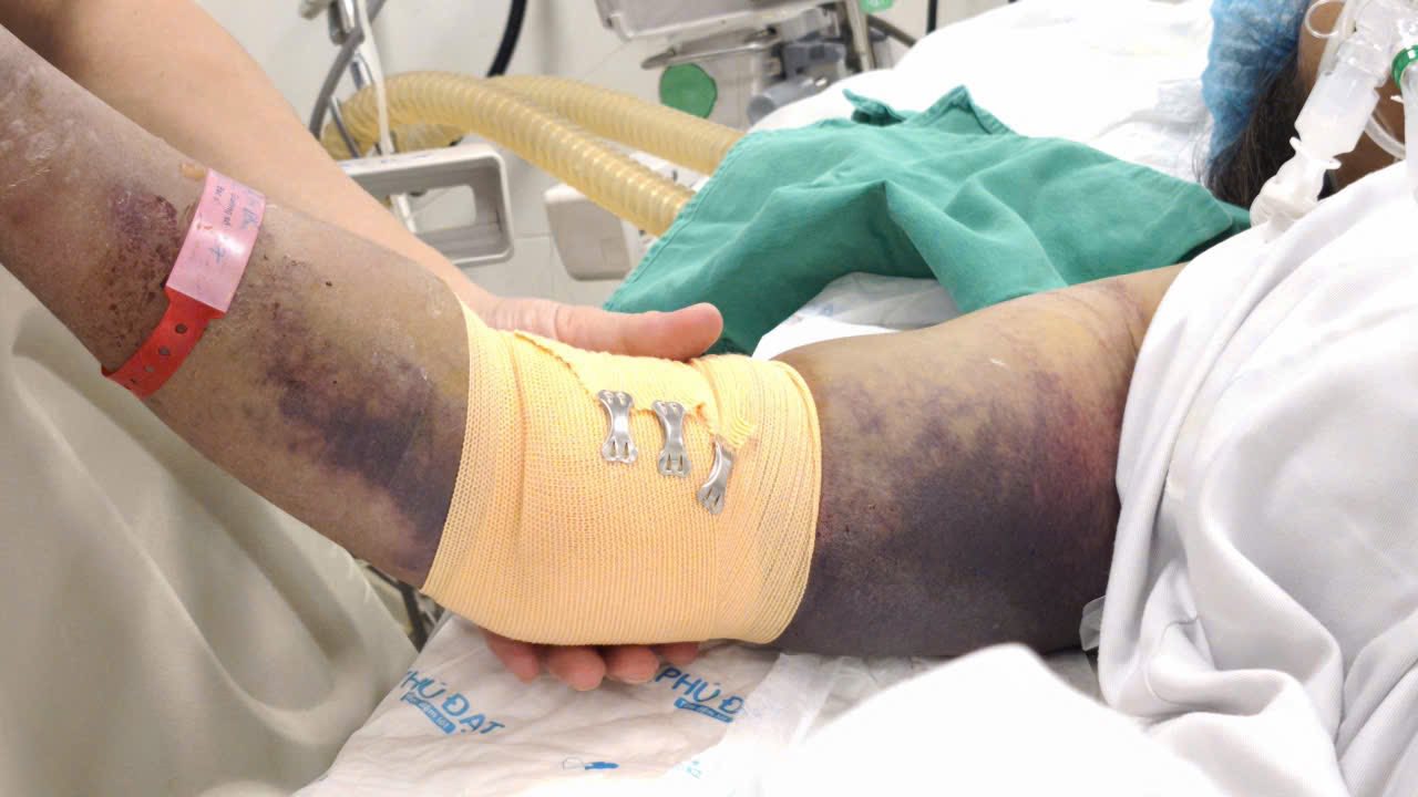 Bệnh nhân sốt xuất huyết biến chứng nặng tại Bệnh viện Bệnh Nhiệt đới Trung ương - ảnh: T.S