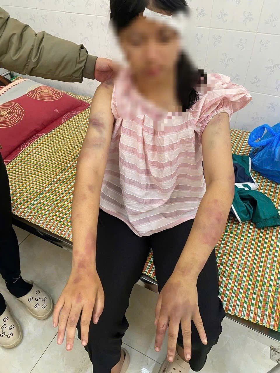 Cháu P.A với các vết thương chằn chịt trên người 