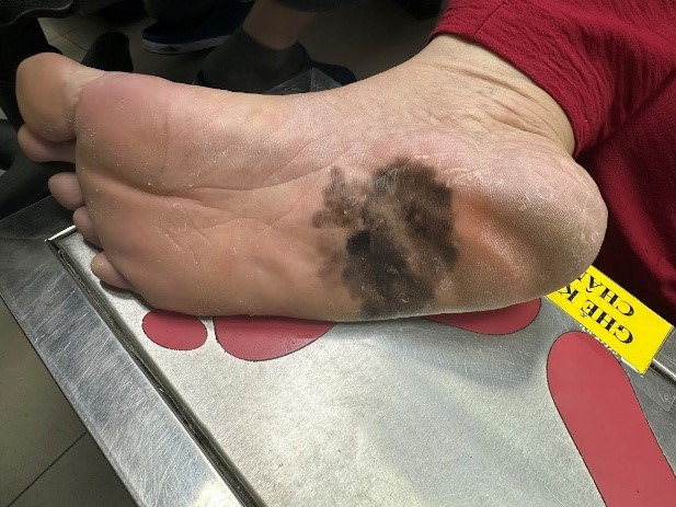 Đốm đen trên da lan tỏa theo thời gian - là một trong những dấu hiệu của ung thư hắc sắc tố