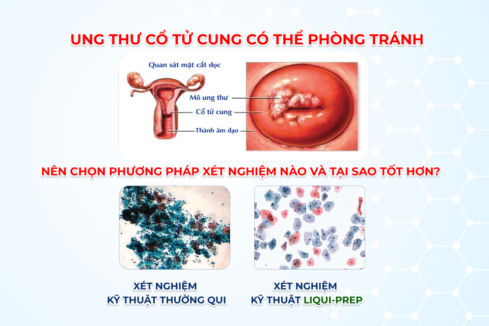 Pap LiquiPrep mang nhiều ưu điểm vượt trội, giúp phát hiện sớm dấu hiệu bệnh lý