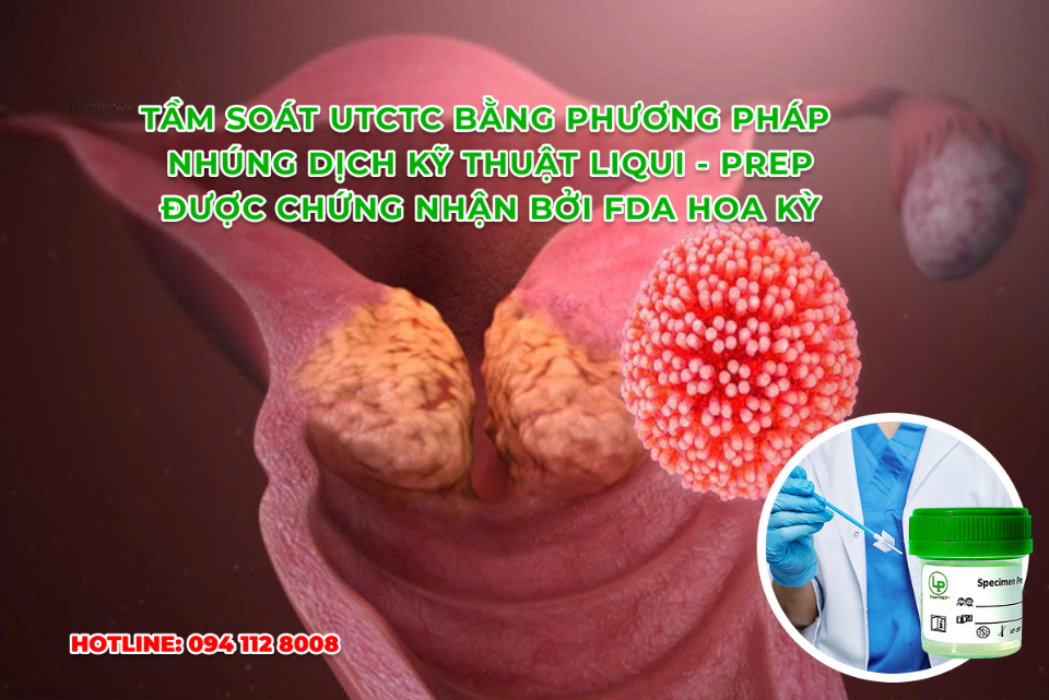 Pap kỹ thuật LiquiPrep - Hình thức tầm soát UTCTC bằng phương pháp nhúng dịch