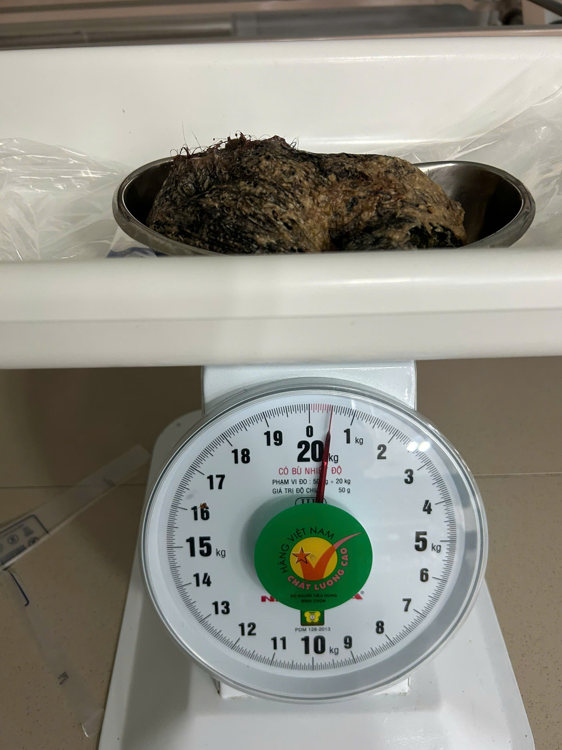 Các bác sỹ phẫu thuật thành công lấy búi tóc 0,5kg ra khỏi dạ dày bệnh nhi_Ảnh: BV Sản-Nhi tỉnh Quảng Ngãi.