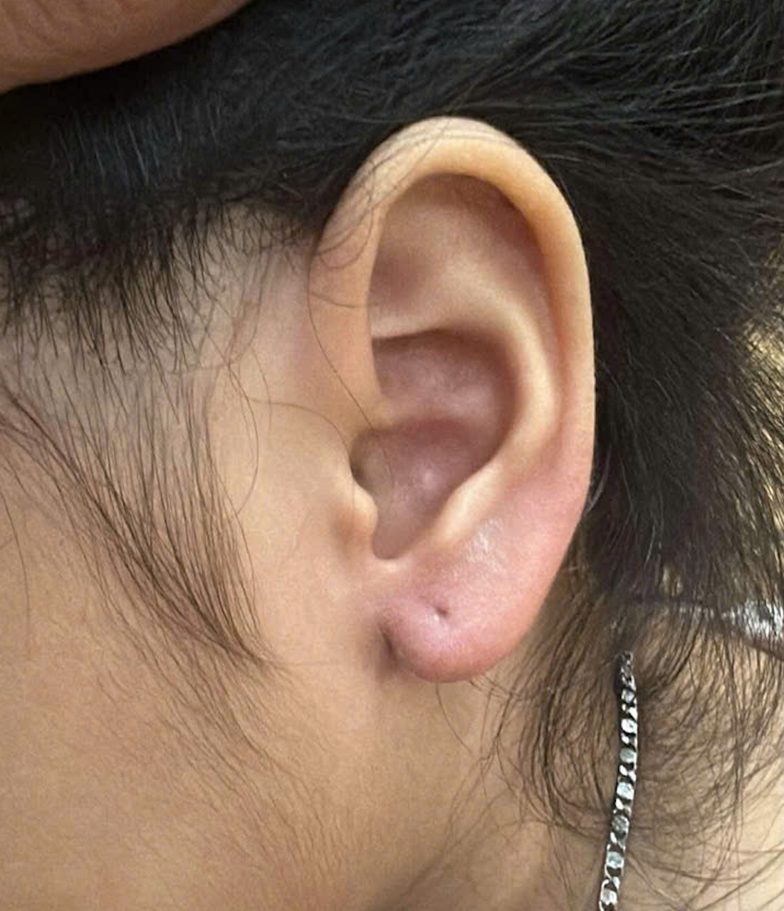 Vùng tai của bé gái bị trầy xước. Ảnh: NNCC