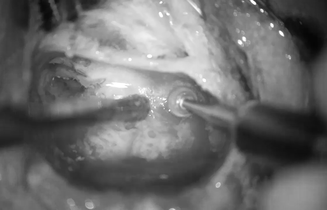 Ca phẫu thuật cấy ốc tai điện tử trở nên nhẹ nhàng hơn khi chuẩn bị kỹ về CT Scan, ảnh BVCC