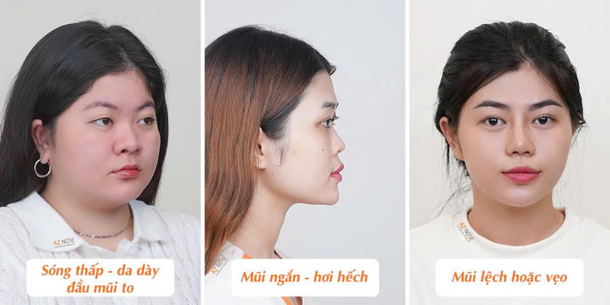 Khách hàng T.Q., T.V. và C.T. trước khi nâng mũi tại AZ NOSE - Ảnh: AZ NOSE