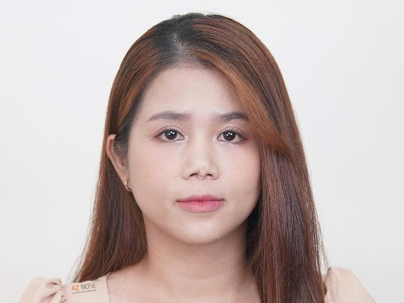 Khách hàng N.L. trước khi tái tạo mũi hỏng tại Phòng khám chuyên nâng mũi AZ NOSE - Ảnh: AZ NOSE