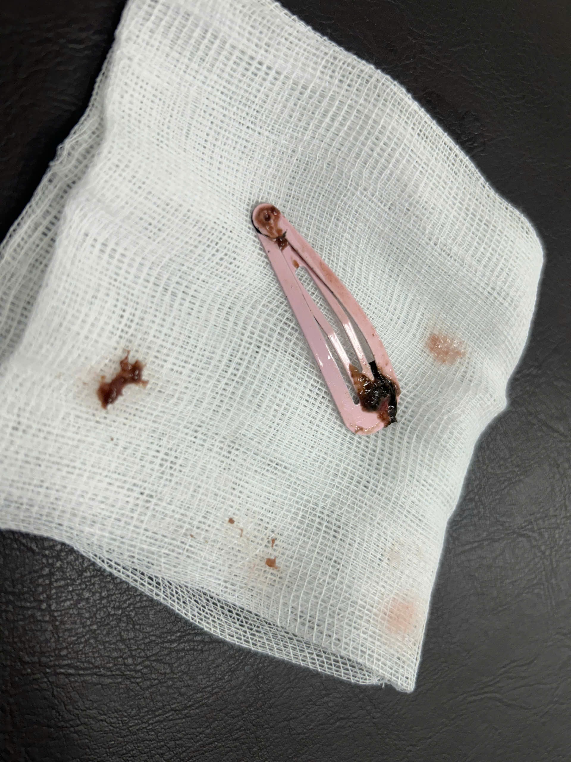 Các bác sỹ gắp thành công kẹp tóc ra khỏi bụng bé gai-Ảnh: Bệnh viện cung cấp.