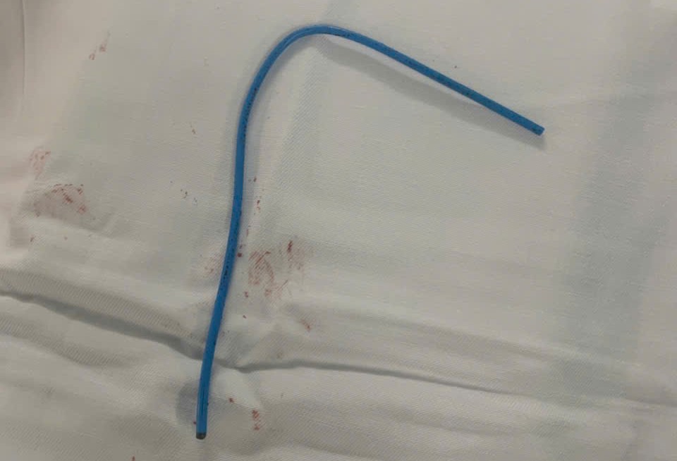 Ống truyền hóa chất bị đứt trôi vào tim bệnh nhân, ảnh BVCC