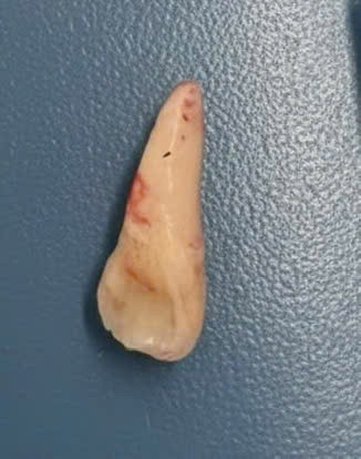 Chiếc răng gãy bị hít vào khí quản được bác sĩ can thiệp nội soi lấy ra ngoài, ảnh BVCC