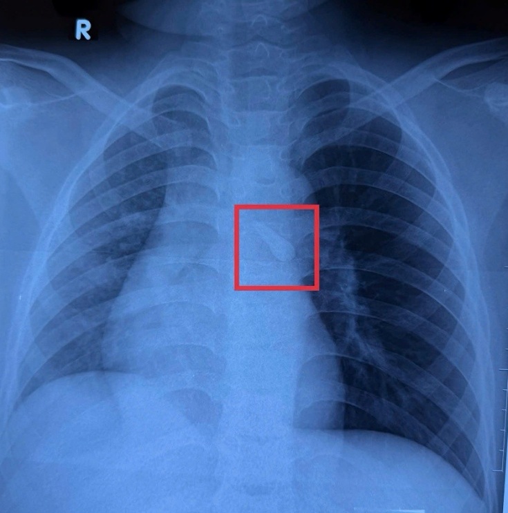 Ghi nhận trên phim Xquang cho thấy bé K. bị sặc dị vật vào khí quản sau tai nạn giao thông, ảnh BVCC