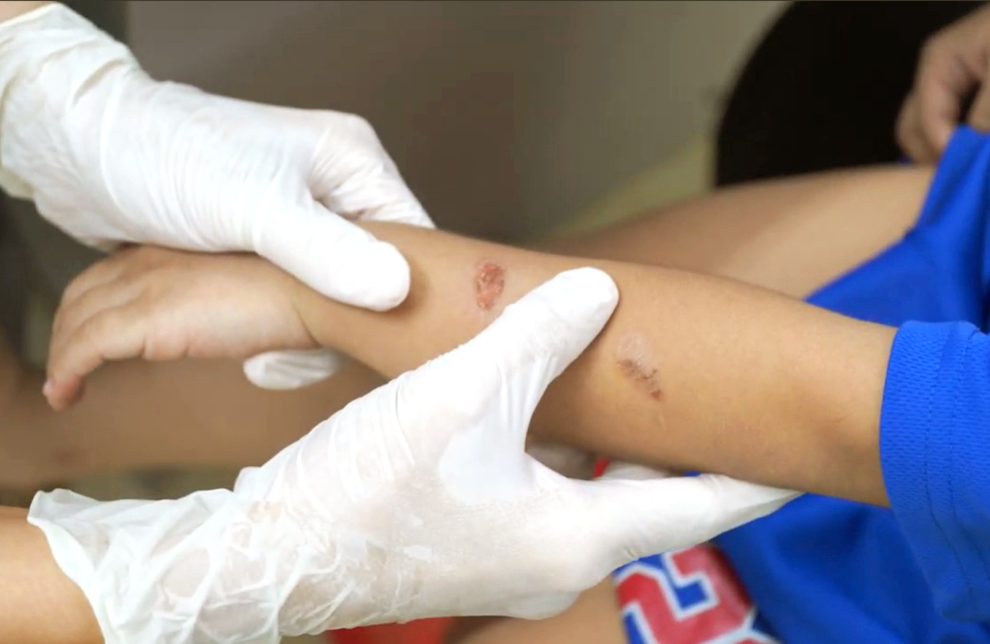 Bệnh chốc gia tăng ở trẻ, cha mẹ không nên tự ý điều trị Từ vài nốt ở tay, bé trai được người nhà điều trị sai cách nên bệnh chốc lan ra cả chân