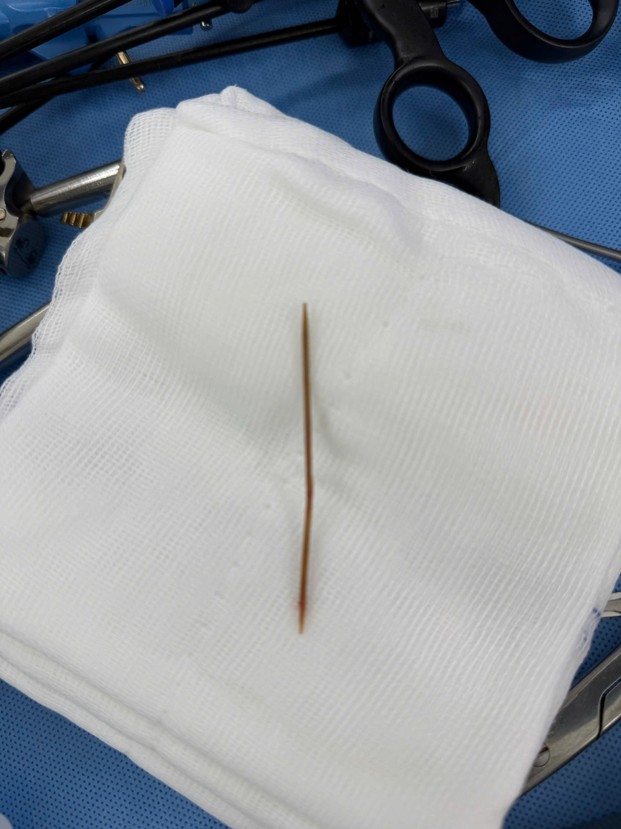 Chiếc tăm tre làm nữ bệnh nhân bị hóc dị vật được lấy ra ngoài, ảnh BVCC