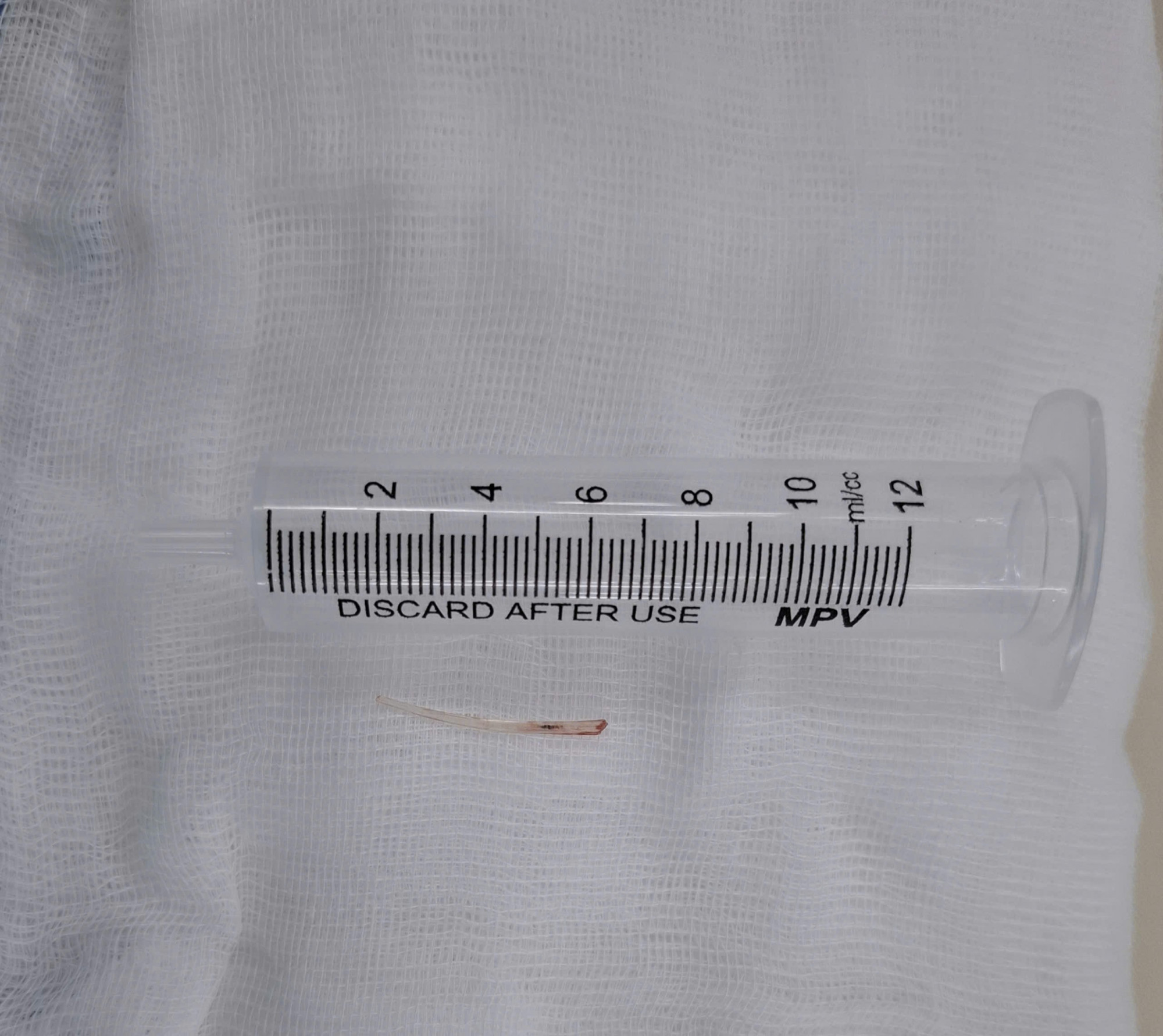 Một mảnh xương cá nhỏ cũng có thể gây nguy hiểm đến tính mạng nếu chủ quan, ảnh BVCC